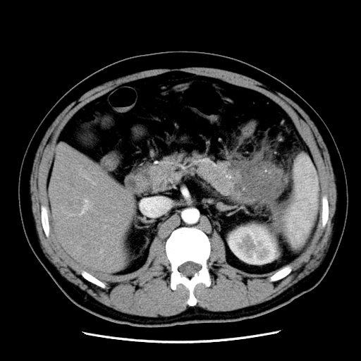【病例】胰腺尾部坏死性胰腺炎1例CT影像表现 【病例】胰腺尾部坏死性胰腺炎1例CT影像表现