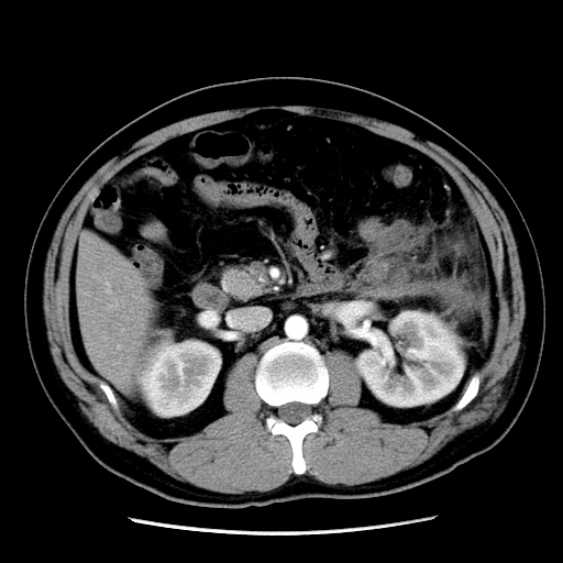 【病例】胰腺尾部坏死性胰腺炎1例CT影像表现 【病例】胰腺尾部坏死性胰腺炎1例CT影像表现