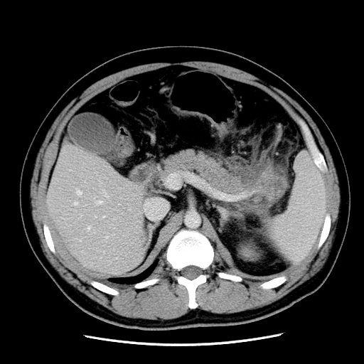 【病例】胰腺尾部坏死性胰腺炎1例CT影像表现 【病例】胰腺尾部坏死性胰腺炎1例CT影像表现