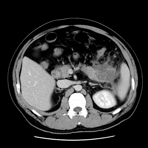 【病例】胰腺尾部坏死性胰腺炎1例CT影像表现 【病例】胰腺尾部坏死性胰腺炎1例CT影像表现