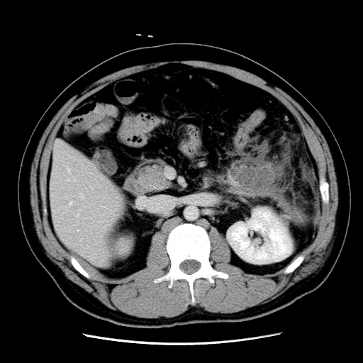 【病例】胰腺尾部坏死性胰腺炎1例CT影像表现 【病例】胰腺尾部坏死性胰腺炎1例CT影像表现