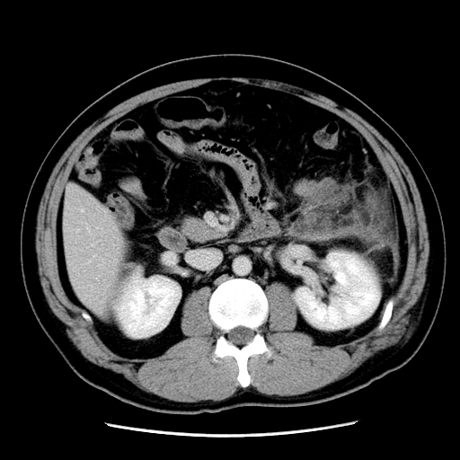 【病例】胰腺尾部坏死性胰腺炎1例CT影像表现 【病例】胰腺尾部坏死性胰腺炎1例CT影像表现