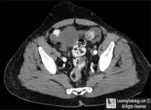 【病例】腹膜假性粘液瘤1例CT影像表现 【病例】腹膜假性粘液瘤1例CT影像表现