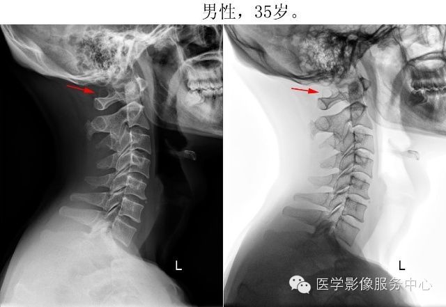 环椎后桥的影像解读