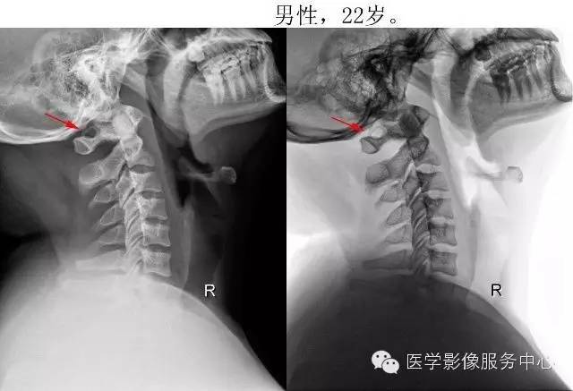 环椎后桥的影像解读 环椎后桥的影像解读