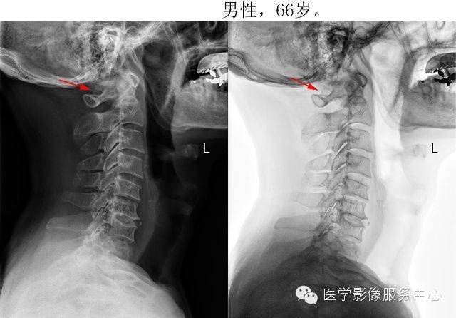 环椎后桥的影像解读 环椎后桥的影像解读