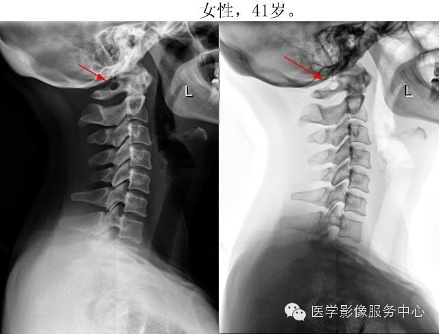 环椎后桥的影像解读 环椎后桥的影像解读