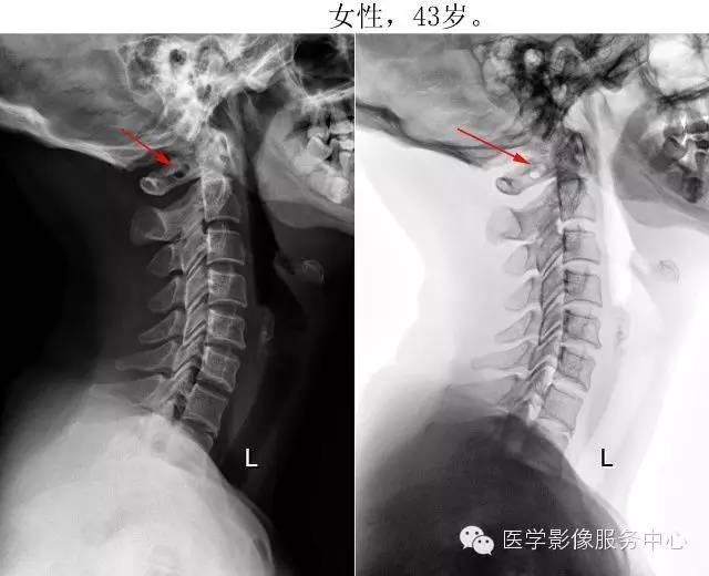 环椎后桥的影像解读 环椎后桥的影像解读