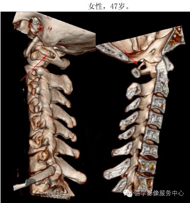 环椎后桥的影像解读 环椎后桥的影像解读