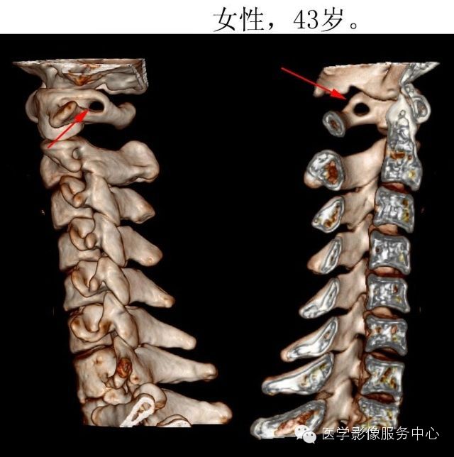 环椎后桥的影像解读 环椎后桥的影像解读