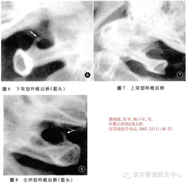 环椎后桥的影像解读 环椎后桥的影像解读