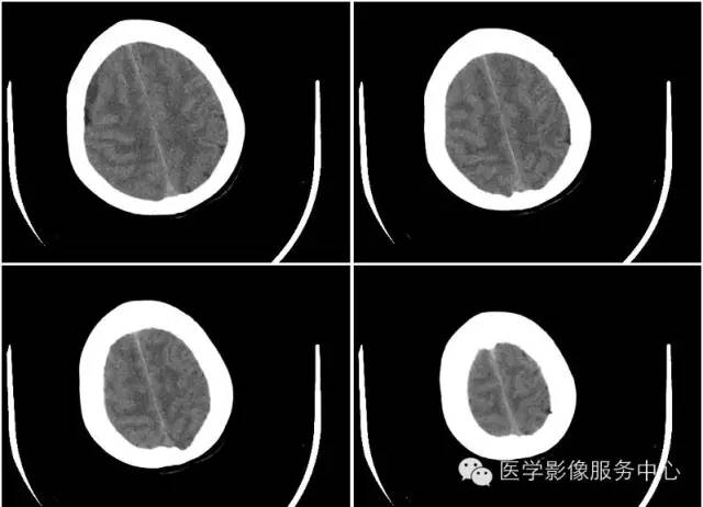 【病例】少突胶质细胞瘤1例CT影像表现 【病例】少突胶质细胞瘤1例CT影像表现