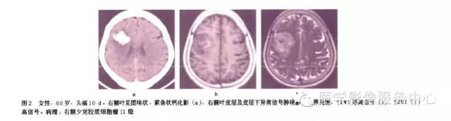 【病例】少突胶质细胞瘤1例CT影像表现 【病例】少突胶质细胞瘤1例CT影像表现