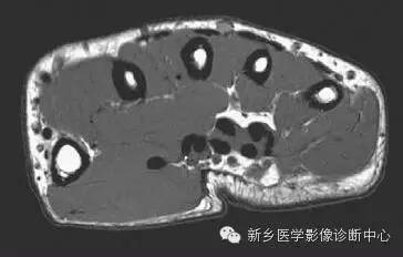手指磁共振断层解剖+详细标注