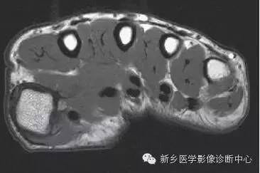 手指磁共振断层解剖+详细标注