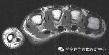 手指磁共振断层解剖+详细标注