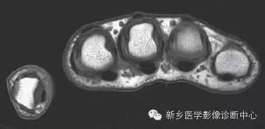 手指磁共振断层解剖+详细标注
