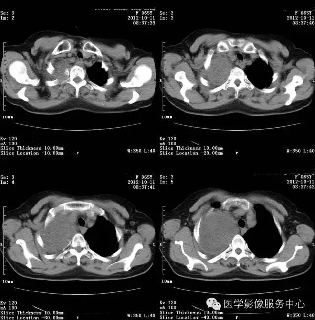 【病例】肺错构瘤1例CT影像表现