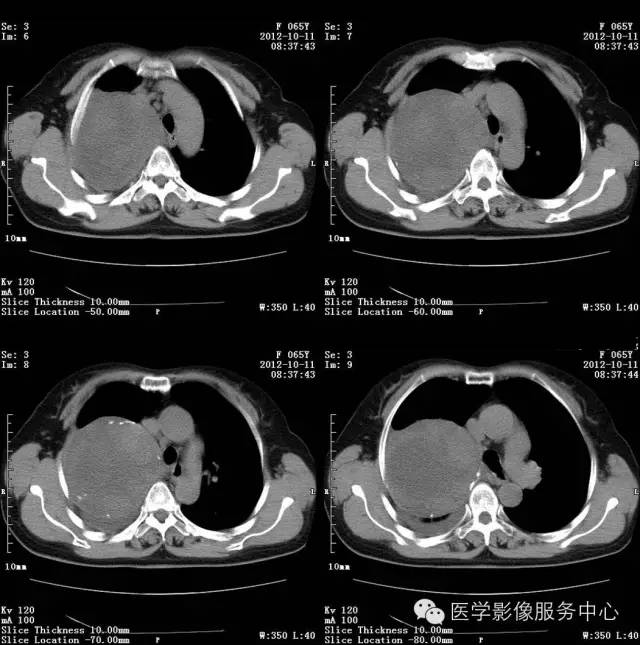 【病例】肺错构瘤1例CT影像表现 【病例】肺错构瘤1例CT影像表现