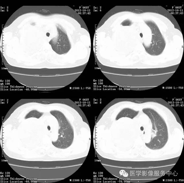 【病例】肺错构瘤1例CT影像表现 【病例】肺错构瘤1例CT影像表现