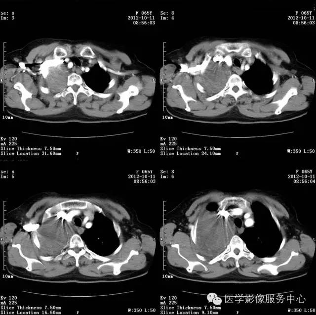 【病例】肺错构瘤1例CT影像表现 【病例】肺错构瘤1例CT影像表现