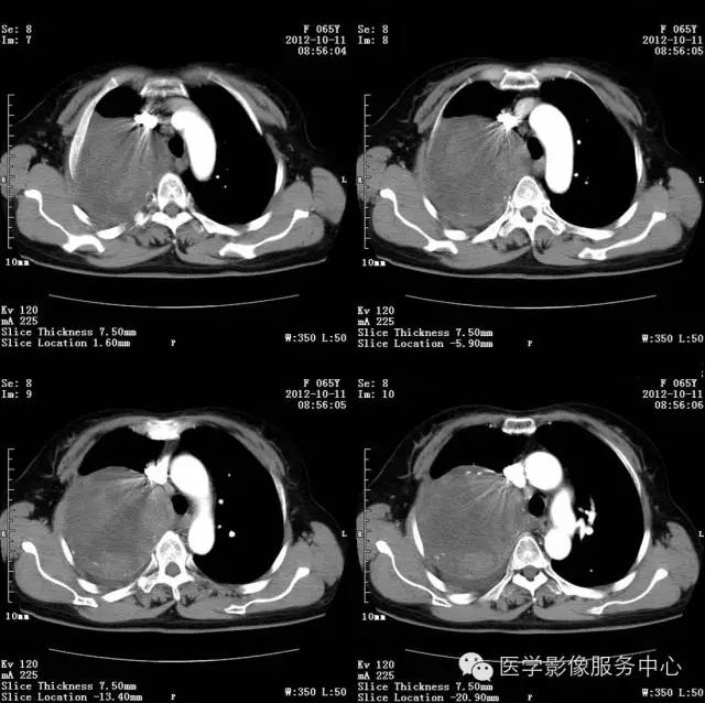 【病例】肺错构瘤1例CT影像表现 【病例】肺错构瘤1例CT影像表现