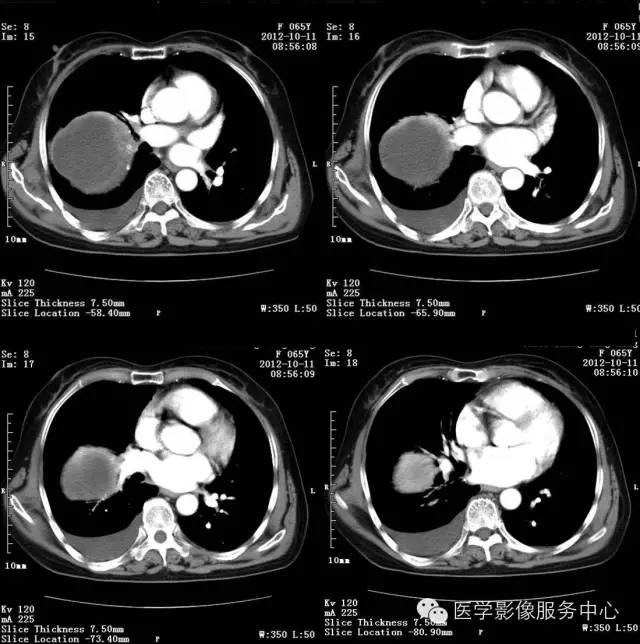 【病例】肺错构瘤1例CT影像表现 【病例】肺错构瘤1例CT影像表现