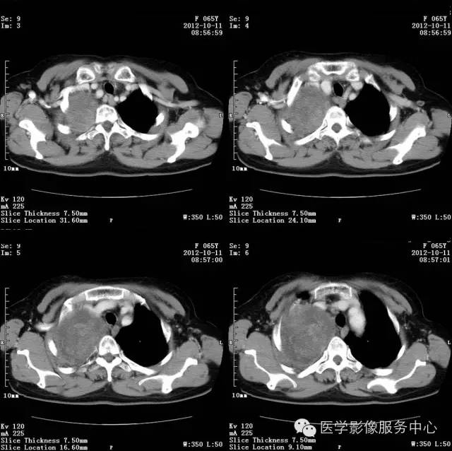 【病例】肺错构瘤1例CT影像表现 【病例】肺错构瘤1例CT影像表现