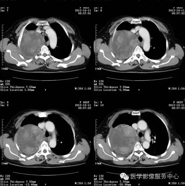 【病例】肺错构瘤1例CT影像表现 【病例】肺错构瘤1例CT影像表现