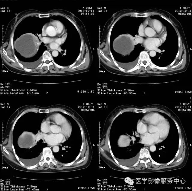 【病例】肺错构瘤1例CT影像表现 【病例】肺错构瘤1例CT影像表现