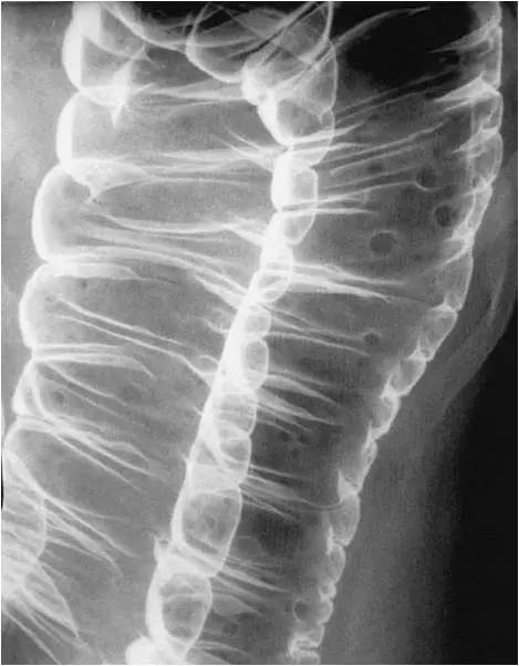 消化系统结节病 消化系统结节病