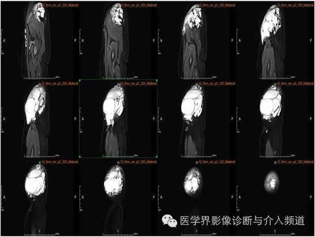【病例】皮下淋巴管瘤1例MR影像表现 【病例】皮下淋巴管瘤1例MR影像表现