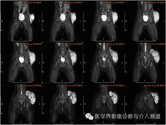 【病例】皮下淋巴管瘤1例MR影像表现