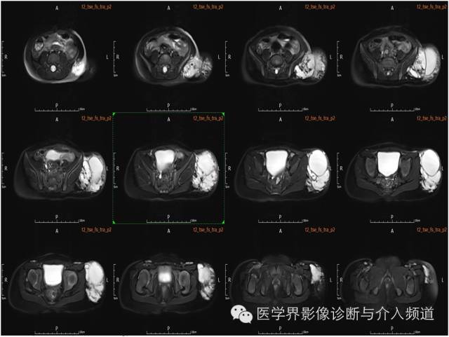 【病例】皮下淋巴管瘤1例MR影像表现 【病例】皮下淋巴管瘤1例MR影像表现