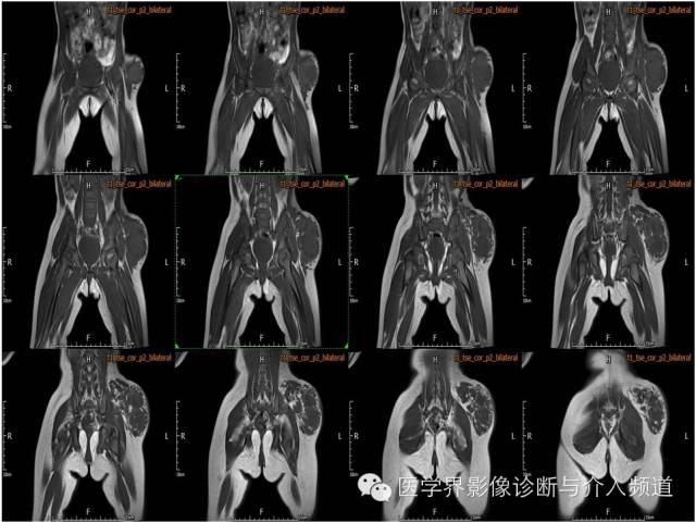 【病例】皮下淋巴管瘤1例MR影像表现 【病例】皮下淋巴管瘤1例MR影像表现
