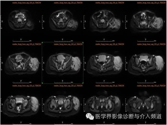 【病例】皮下淋巴管瘤1例MR影像表现 【病例】皮下淋巴管瘤1例MR影像表现
