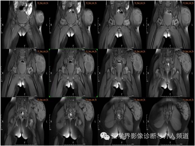 【病例】皮下淋巴管瘤1例MR影像表现 【病例】皮下淋巴管瘤1例MR影像表现