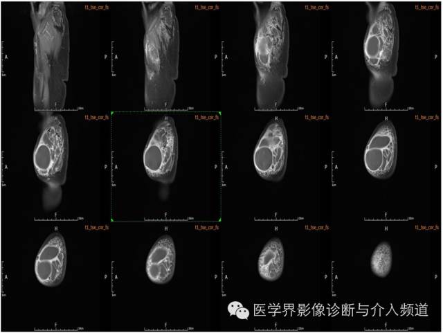 【病例】皮下淋巴管瘤1例MR影像表现 【病例】皮下淋巴管瘤1例MR影像表现