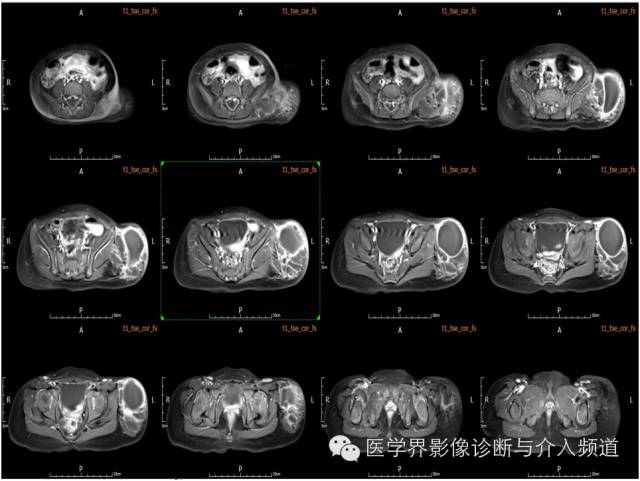 【病例】皮下淋巴管瘤1例MR影像表现 【病例】皮下淋巴管瘤1例MR影像表现