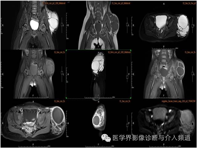 【病例】皮下淋巴管瘤1例MR影像表现 【病例】皮下淋巴管瘤1例MR影像表现
