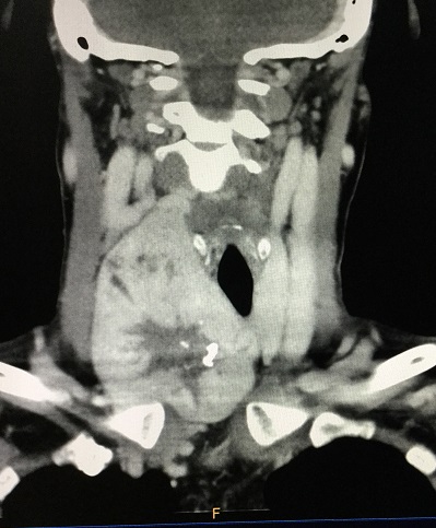 【病例】甲状腺乳头状癌1例CT影像表现 【病例】甲状腺乳头状癌1例CT影像表现