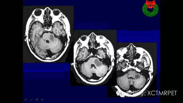 脑肿瘤的MRI