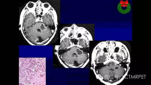 脑肿瘤的MRI