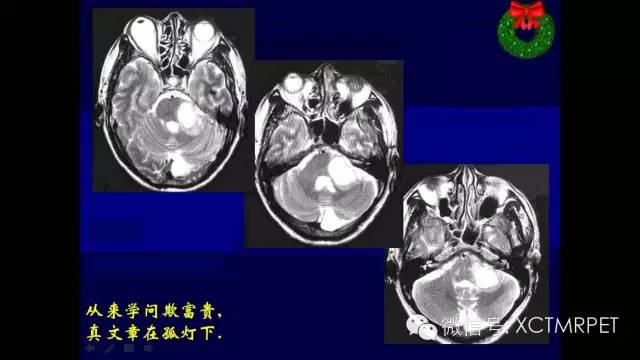 脑肿瘤的MRI