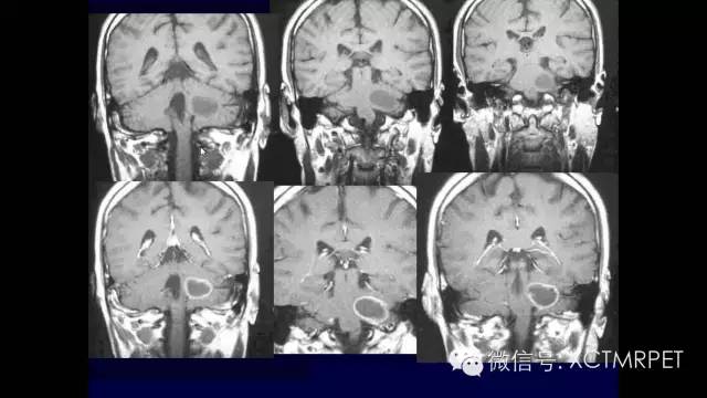 脑肿瘤的MRI