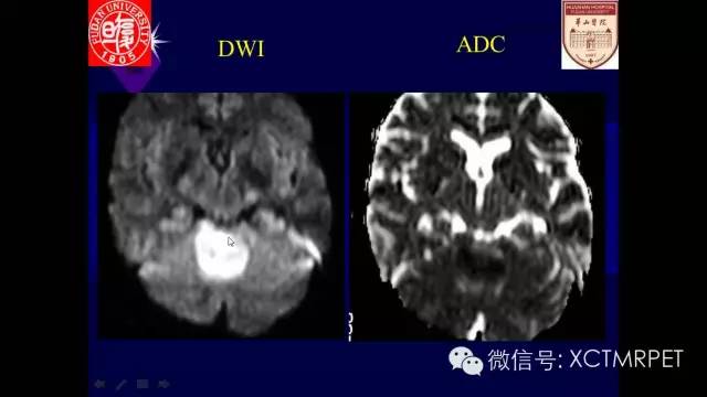 脑肿瘤的MRI