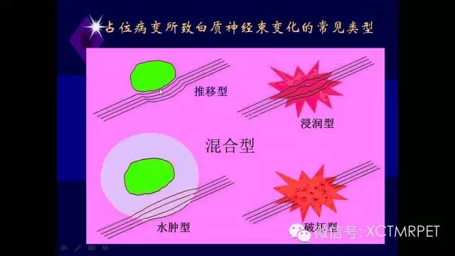 脑肿瘤的MRI