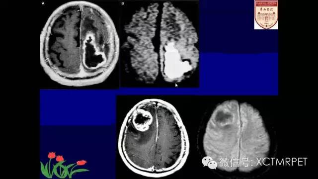 脑肿瘤的MRI
