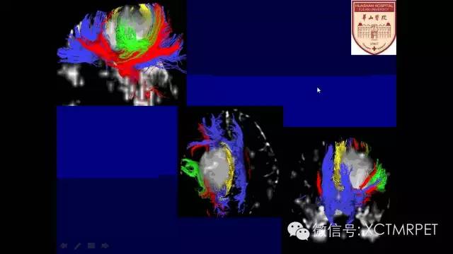 脑肿瘤的MRI