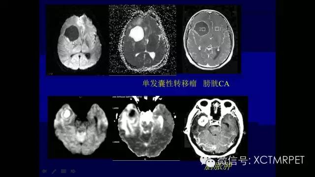 脑肿瘤的MRI
